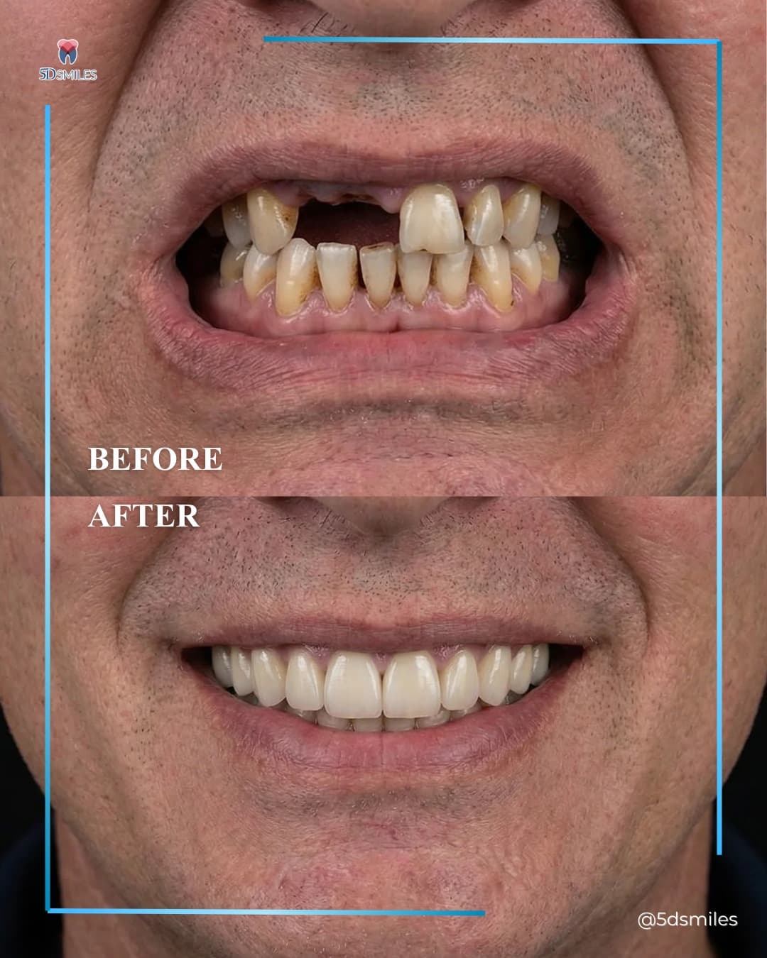 5D Smiles patient case 5 — before and after