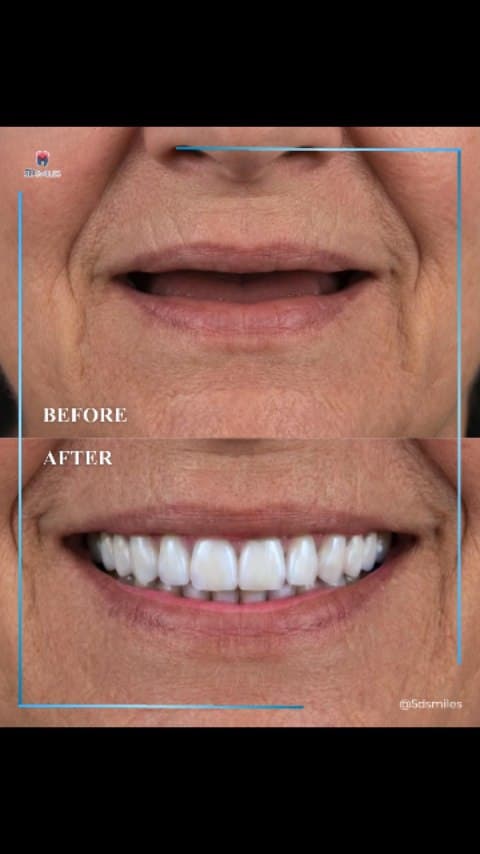 Dr. Qiu dental implant case 2